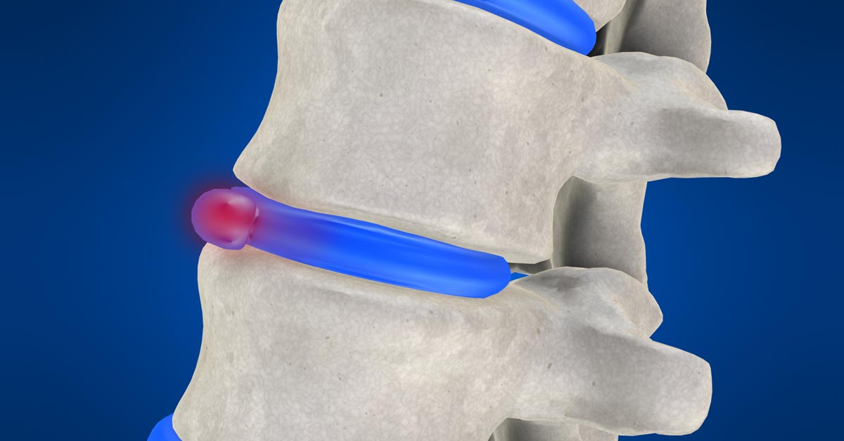 Mt Sterling non-surgical disc herniation treatment