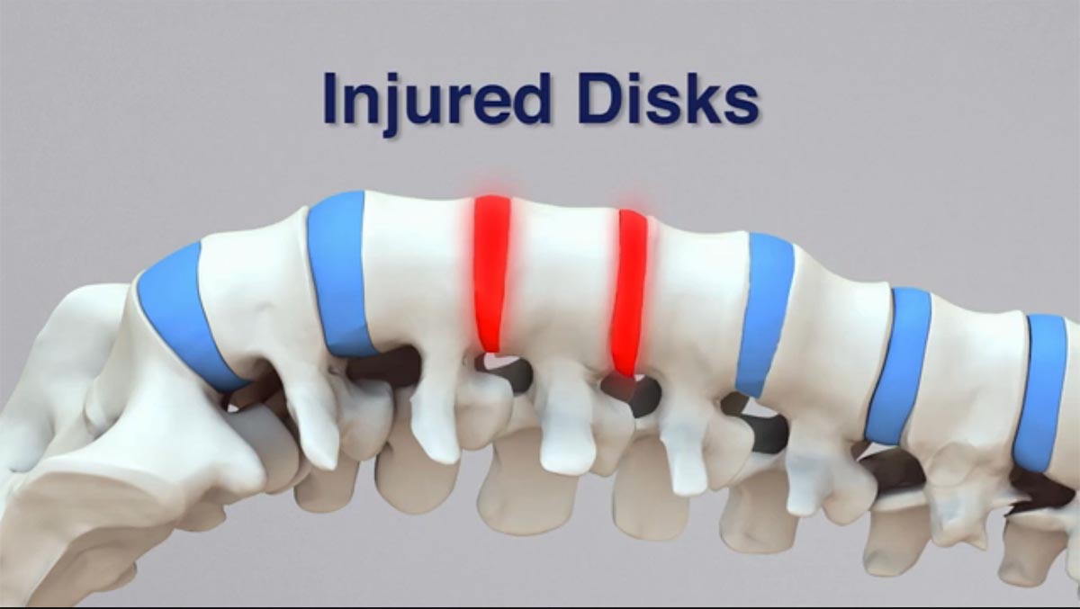 Mt Sterling non-surgical spinal decompression